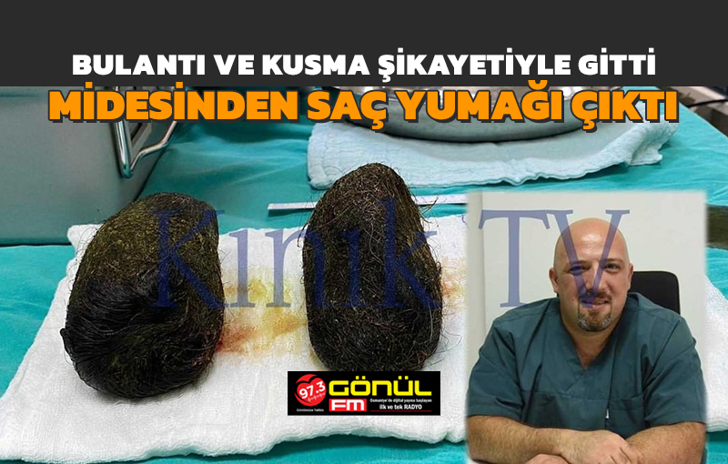 Bulantı ve kusma şikâyetiyle gitti, midesinden saç yumağı çıktı